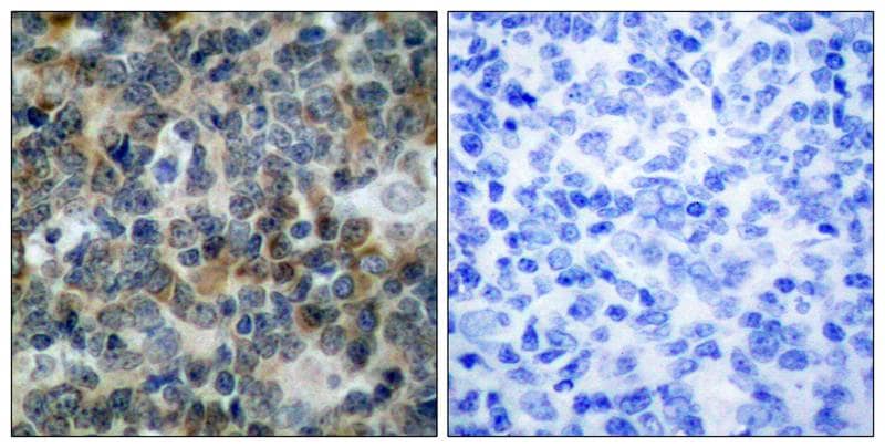 Immunohistochemistry-Paraffin: VASP [p Ser238] Antibody [NB100-82254] - Immunohistochemical analysis of paraffin-embedded human tonsil carcinoma tissue, using NB100-82254(left) or the same antibody preincubated with blocking peptide(right).