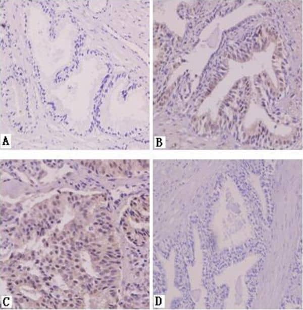 Immunohistochemistry: AG-2/AGR2 Antibody - BSA Free [NB110-17780] - SATB1 immunohistochemistry staining. A, benign prostate hyperplasia. B, prostatic carcinoma with metastasis. C, prostatic carcinoma without metastasis. D, negative control. Magnification: 400 × . Image collected & cropped by CiteAb from the following publication (//pubmed.ncbi.nlm.nih.gov/23642278), licensed under a CC-BY license. Not internally tested by Novus Biologicals.