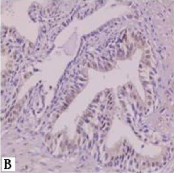 Immunohistochemistry: AG-2/AGR2 Antibody - BSA Free [NB110-17780] - SATB1 immunohistochemistry staining. A, benign prostate hyperplasia. B, prostatic carcinoma with metastasis. C, prostatic carcinoma without metastasis. D, negative control. Magnification: 400 × . Image collected & cropped by CiteAb from the following publication (//pubmed.ncbi.nlm.nih.gov/23642278), licensed under a CC-BY license. Not internally tested by Novus Biologicals.