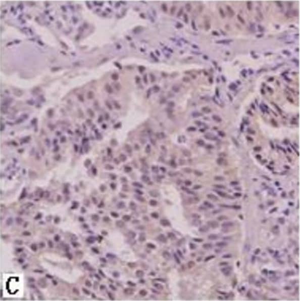 Immunohistochemistry: AG-2/AGR2 Antibody - BSA Free [NB110-17780] - SATB1 immunohistochemistry staining. A, benign prostate hyperplasia. B, prostatic carcinoma with metastasis. C, prostatic carcinoma without metastasis. D, negative control. Magnification: 400 × . Image collected & cropped by CiteAb from the following publication (//pubmed.ncbi.nlm.nih.gov/23642278), licensed under a CC-BY license. Not internally tested by Novus Biologicals.