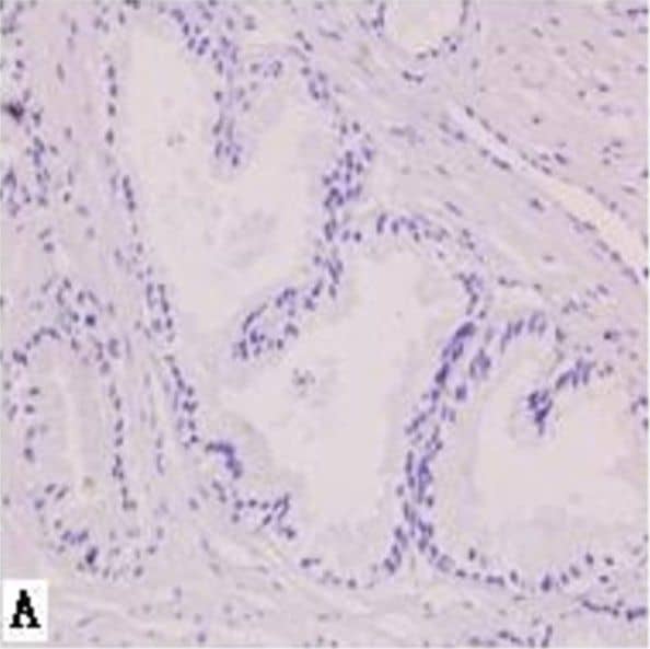 Immunohistochemistry: AG-2/AGR2 Antibody - BSA Free [NB110-17780] - SATB1 immunohistochemistry staining. A, benign prostate hyperplasia. B, prostatic carcinoma with metastasis. C, prostatic carcinoma without metastasis. D, negative control. Magnification: 400 × . Image collected & cropped by CiteAb from the following publication (//pubmed.ncbi.nlm.nih.gov/23642278), licensed under a CC-BY license. Not internally tested by Novus Biologicals.