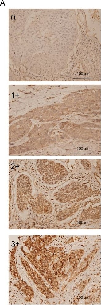(A) ATG5 expression in ESCC tissue was analyzed by IHC and scored as 0, 1+, 2+, and 3+. (B) Expression level of ATG5 in adjacent non-cancerous (normal) and early-stage ESCC tissues by IHC. (C-D) Kaplan–Meier estimates of OS (C) and PFS (D) by the expression levels of ATG5 (low and high) of adjacent normal tissue from early-stage ESCC patients. MST: median survival time. Low, expression score 0 or 1+; High, expression score 2+ or 3+.