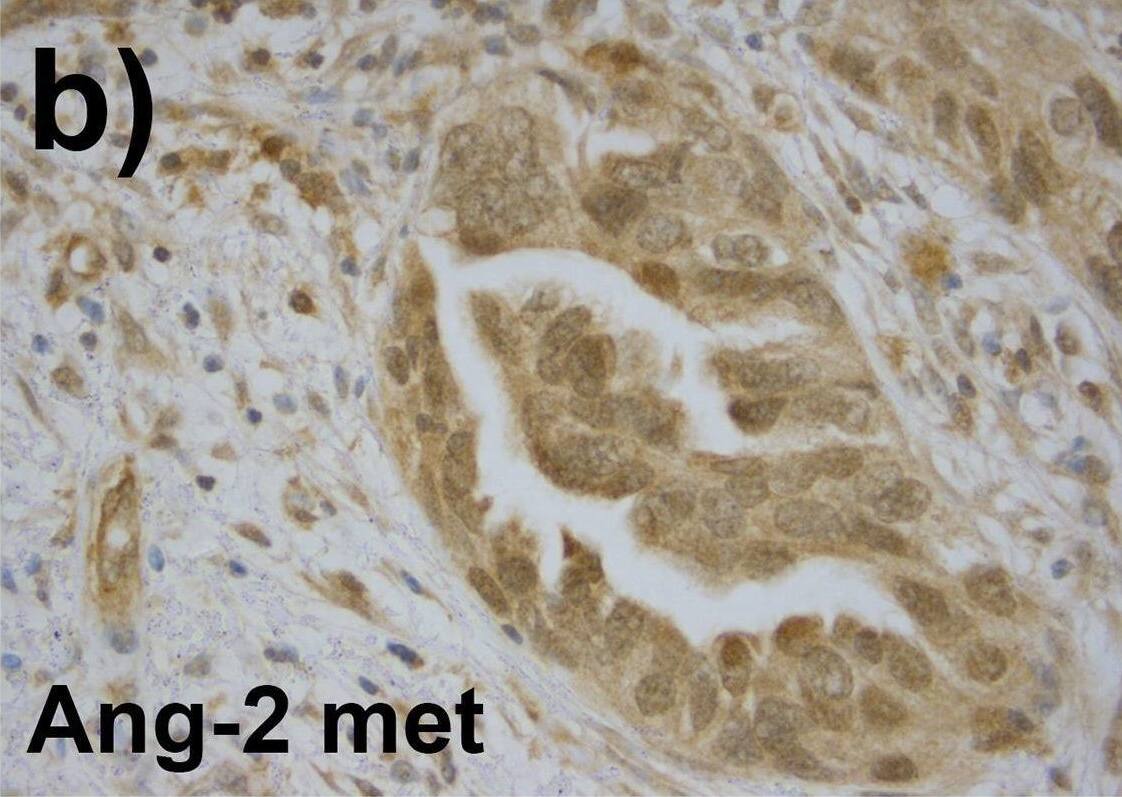 As compared to the primary tumors, related omental metastases showed stronger expression of Ang-2 (a and b) and Tie-2 (e and f). Primary tumors are shown on the left column and related metastases on the right. The vascular endothelial expression was strong in Ang-2 (black arrow in a). Tie-1 expression did not differ significantly between the primary and the distal metastatic tumors (c and d). Tie-1 was expressed in the tumor stroma (black arrow in d). Image collected and cropped by CiteAb from the following open publication (//pubmed.ncbi.nlm.nih.gov/33151982), licensed under a CC-BY license. Not internally tested by Novus Biologicals.