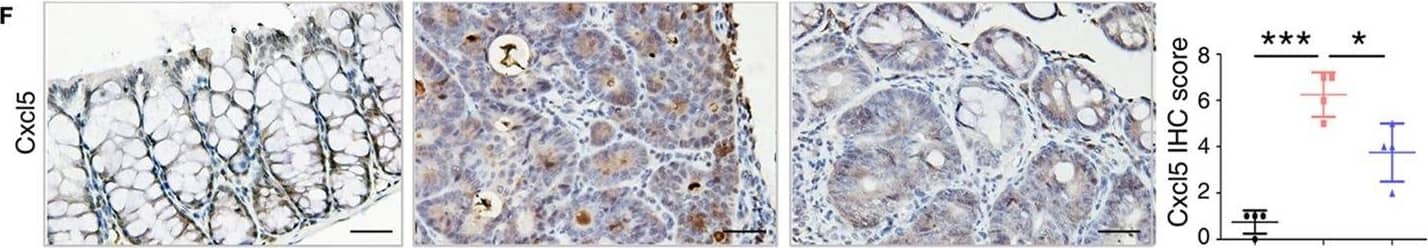 Immunohistochemistry: S100A9 Antibody [NB110-89726] - Key molecules of specific signaling pathways are assayed by immunohistochemistry in the colorectum of mice. Immunohistochemistry (200× magnification) of (A) S100a9, (B)  beta -catenin, (C) c-Myc, (D) p-Akt, (E) p-Smad2, & (F) Cxcl5 in normal control, IgG Ab, & anti-S100a9 Ab-treated colorectal tissues of the colitis-associated cancer mouse (n = 4). Scale bar, 50 µm. Staining scores were determined by semi-quantitative optical analysis. Image collected & cropped by CiteAb from the following publication (//pubmed.ncbi.nlm.nih.gov/29326691), licensed under a CC-BY license. Not internally tested by Novus Biologicals.