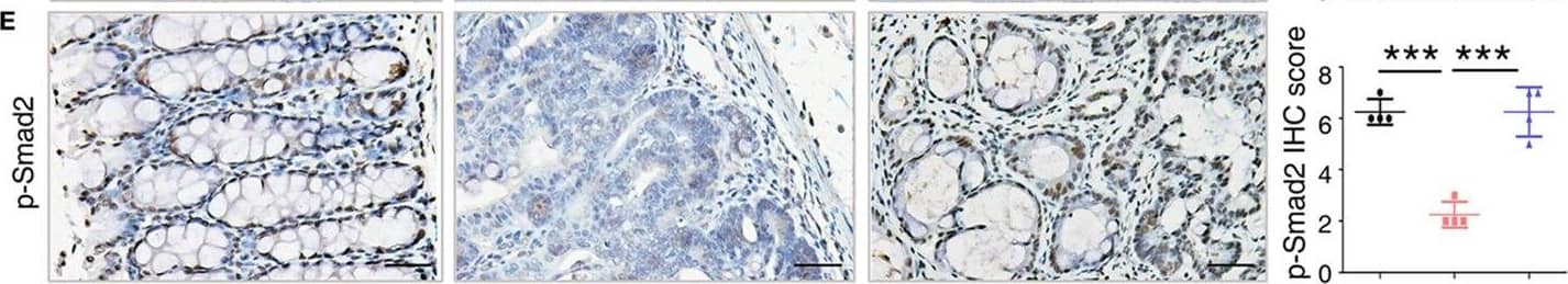 Immunohistochemistry: S100A9 Antibody [NB110-89726] - Key molecules of specific signaling pathways are assayed by immunohistochemistry in the colorectum of mice. Immunohistochemistry (200× magnification) of (A) S100a9, (B)  beta -catenin, (C) c-Myc, (D) p-Akt, (E) p-Smad2, & (F) Cxcl5 in normal control, IgG Ab, & anti-S100a9 Ab-treated colorectal tissues of the colitis-associated cancer mouse (n = 4). Scale bar, 50 µm. Staining scores were determined by semi-quantitative optical analysis. Image collected & cropped by CiteAb from the following publication (//pubmed.ncbi.nlm.nih.gov/29326691), licensed under a CC-BY license. Not internally tested by Novus Biologicals.