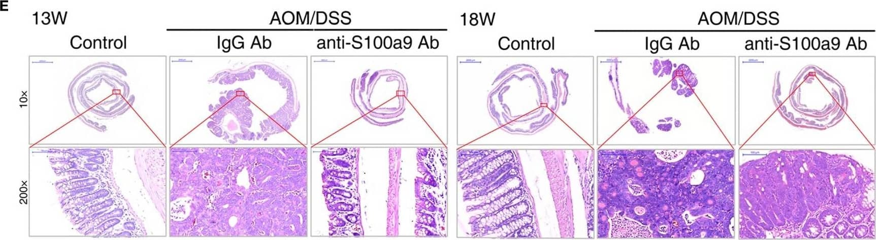 Immunohistochemistry: S100A9 Antibody [NB110-89726] - Effects of anti-S100a9 Ab administration on the azoxymethane (AOM)/dextran sulfate sodium (DSS)-induced colitis-associated cancer development. (A) Experimental procedure of the control group & the AOM/DSS group treated with IgG Ab or anti-S100a9 Ab. (B) DAI of the IgG Ab or anti-S100a9 Ab-treated AOM/DSS mice & normal controls. (C) General observation of the colorectums in mice at the end of the 13th & 18th week. (D) Colon length, tumor rate, & number of macroscopic neoplasms were statisticed at 13 & 18 weeks, individually. n = 5–9 per group. Results were representative of the three experiments performed. (E) Histopathological examination of colon sections was shown under the Pannoramic Viewer (H&E staining, upper panels: original magnification 10×, scale bar: 2000 µm; lower panels: original magnification 200×, scale bar: 100 µm). Image collected & cropped by CiteAb from the following publication (//pubmed.ncbi.nlm.nih.gov/29326691), licensed under a CC-BY license. Not internally tested by Novus Biologicals.