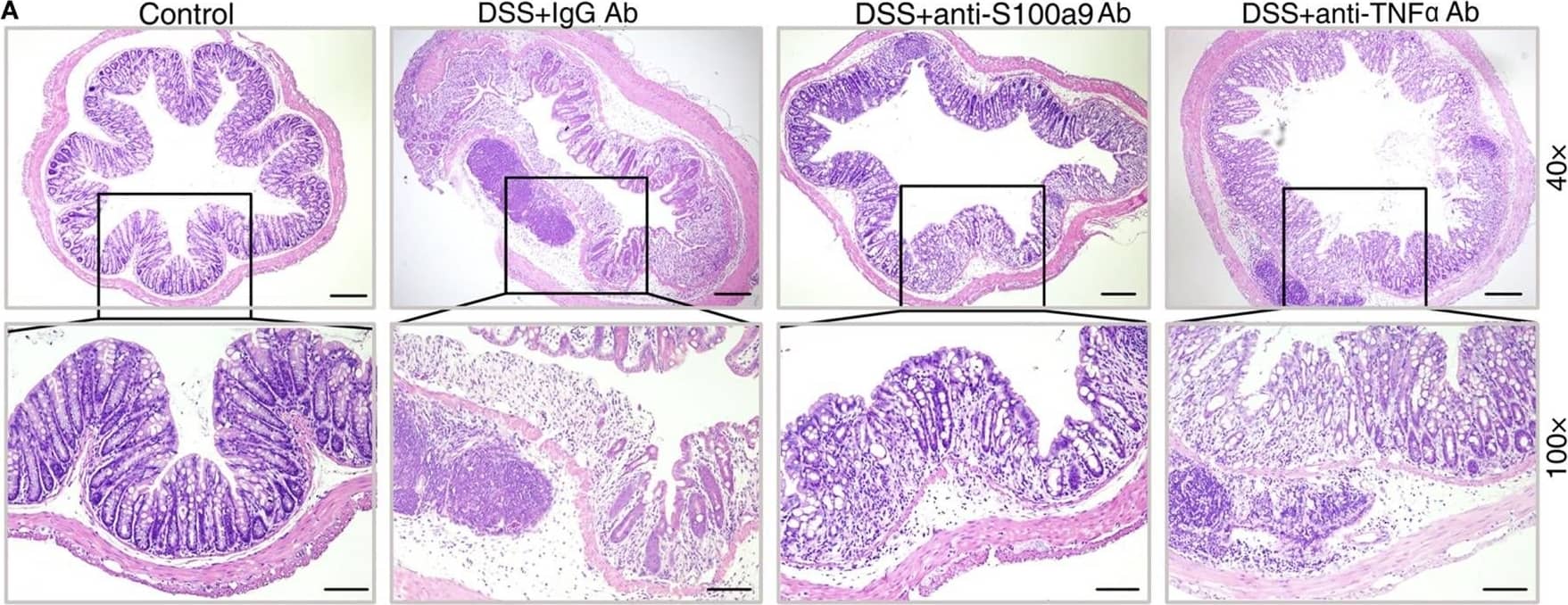 Immunohistochemistry: S100A9 Antibody [NB110-89726] - Anti-S100a9 Ab ameliorates inflammatory response of dextran sulfate sodium (DSS)-induced colitis in mice. (A) 6 days after DSS treatment, representative H&E-stained colon sections were shown (upper panels: original magnification 40×, scale bar: 200 µm; lower panels: original magnification 100×, scale bar: 100 µm). (B) Colon inflammation, ulceration, & crypt damage were scored individually, & composite total score was scored. n = 5 per group. (C) Isolated lymphoid follicles (ILFs) area was measured at day 6. Representative TUNEL staining (D) & ethynyl-2′-deoxyuridine (EdU) staining (E) of normal mice & DSS-induced mice, which were treated with IgG Ab or anti-S100a9 Ab on day 6. The percent of positive cells was measured. At least six fields were counted per mouse. Scale bar, 100 µm. Image collected & cropped by CiteAb from the following publication (//pubmed.ncbi.nlm.nih.gov/29326691), licensed under a CC-BY license. Not internally tested by Novus Biologicals.