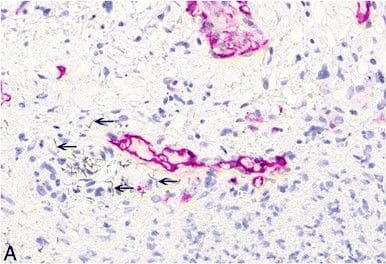 Immunohistochemistry-Paraffin: Podoplanin Antibody (LF3/B7/D5B27) - Azide and BSA Free [NB110-96423] - Non-neoplastic histopathological findings in the abdominal cavity. A: High-power view of anti-podoplanin immunohistochemistry showing single MWCNT A (high dose) nanotubes in the tissue (arrows). B: High-power view of anti-podoplanin immunohistochemistry showing single asbestos fibers in the tissue (arrows). C: H & E, high-power view of granuloma induced by MWCNT A (low dose) nanotubes including single nanotube (arrow, 25×). D: H & E, high-power view of granuloma induced by asbestos including single fiber (arrow, 40×). Image collected & cropped by CiteAb from the following publication (//particleandfibretoxicology.biomedcentral.com/articles/10.1186/s12989-014-0059-z), licensed under a CC-BY license. Not internally tested by Novus Biologicals.