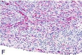 Immunohistochemistry-Paraffin: Podoplanin Antibody (LF3/B7/D5B27) - Azide and BSA Free [NB110-96423] - Sarcomatoid-type malignant mesothelioma observed in the MWCNT B high-dose group. A: H & E, low magnification of tumor tissue invading the diaphragm (20×). B & C: H & E, high-power view (40×). D: High-power view of anti-vimentin immunohistochemistry showing a strongly positive result (40×). E: High-power view of anti-pan-cytokeratin immunohistochemistry showing several positive cells (40×). F: High-power view of anti-podoplanin immunohistochemistry revealing positively stained cytoplasm of many cells (40×). Image collected & cropped by CiteAb from the following publication (//particleandfibretoxicology.biomedcentral.com/articles/10.1186/s12989-014-0059-z), licensed under a CC-BY license. Not internally tested by Novus Biologicals.