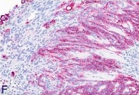 Immunohistochemistry-Paraffin: Podoplanin Antibody (LF3/B7/D5B27) - Azide and BSA Free [NB110-96423] - Biphasic-type malignant mesothelioma observed in the amosite asbestos group. A: H & E, low magnification of tumor tissue found on the liver surface (10×). B: H & E, higher magnification (20×). C: H & E, high-power view (40×). D: High-power view of anti-vimentin immunohistochemistry showing a strongly positive result (40×). E: High-power view of anti-pan-cytokeratin immunohistochemistry showing positive staining of many cells (40×). F: High-power view of anti-podoplanin immunohistochemistry revealing positivity in distinct parts of the tumor. Image collected & cropped by CiteAb from the following publication (//particleandfibretoxicology.biomedcentral.com/articles/10.1186/s12989-014-0059-z), licensed under a CC-BY license. Not internally tested by Novus Biologicals.