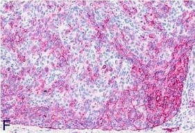 Immunohistochemistry-Paraffin: Podoplanin Antibody (LF3/B7/D5B27) - Azide and BSA Free [NB110-96423] - Biphasic-type malignant mesothelioma observed in the MWCNT D low-dose group. A: H & E, low magnification of tumor tissue found on the surface of the omentum (20×). B & C: H & E, high-power view (40×). D: High-power view of anti-vimentin immunohistochemistry showing a strongly positive result (40×). E: High-power view of anti-pan-cytokeratin immunohistochemistry showing positive staining of the majority of cells (40×). F: High-power view of anti-podoplanin immunohistochemistry revealing positively stained cytoplasm of many cells (40×). Image collected & cropped by CiteAb from the following publication (//particleandfibretoxicology.biomedcentral.com/articles/10.1186/s12989-014-0059-z), licensed under a CC-BY license. Not internally tested by Novus Biologicals.