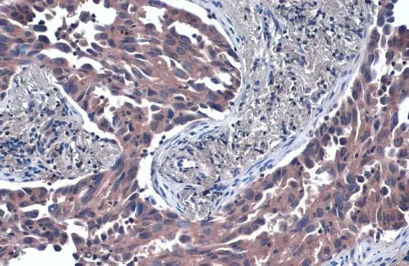 Immunohistochemistry-Paraffin: TSG101 Antibody (4A10) [NB200-112] - TSG101 antibody [4A10] detects TSG101 protein at cytoplasm by immunohistochemical analysis.Sample: Paraffin-embedded human lung cancer.TSG101 stained by TSG101 antibody [4A10] (NB200-112) diluted at 1:50.Antigen Retrieval: Citrate buffer, pH 6.0, 15 min