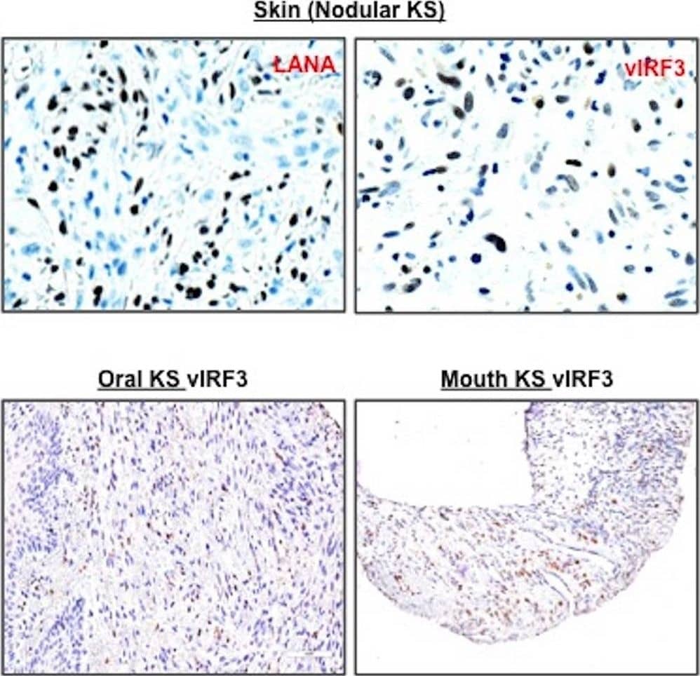 Immunohistochemistry: LANA2 Antibody (CM-A807) - BSA Free [NB200-167] - vIRF3 expression in KS tissues. We obtained KS tissue microarrays from AIDS Cancer Specimen Resource & performed immunohistochemistry, visualized by Aperio F.L. digital pathological scanning. A biopsy sample of KS TMA was stained with anti-LANA & anti-vIRF3 (CM-A807). Representative images show the LANA staining of skin KS lesion & the vIRF3 staining of skin, tonsil, & mouth KS lesions & positive staining corresponding to either LANA or vIRF3 in total KS biopsy specimens embedded in TMA. Image collected & cropped by CiteAb from the following publication (//pubmed.ncbi.nlm.nih.gov/29339432), licensed under a CC-BY license. Not internally tested by Novus Biologicals.