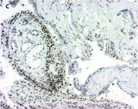 Immunohistochemistry: 15-PGDH/HPGD Antibody [NB200-179] - Expression of 15-prostaglandin dehydrogenase (15-PGDH) in healthy & inflamed synovial tissue. Immunohistochemical staining reveals positive (brown) staining for 15-PGDH (hematoxilin counterstained) in synovial tissue from healthy individuals (a) & patients with rheumatoid arthritis (b), osteoarthritis (c), or psoriatic arthritis (d). Original magnifications: ×250 (a, b), ×100 (c, d). Image collected & cropped by CiteAb from the following publication (//pubmed.ncbi.nlm.nih.gov/22616846), licensed under a CC-BY license. Not internally tested by Novus Biologicals.