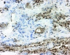 Immunohistochemistry: 15-PGDH/HPGD Antibody [NB200-179] - Expression of 15-prostaglandin dehydrogenase (15-PGDH) in healthy & inflamed synovial tissue. Immunohistochemical staining reveals positive (brown) staining for 15-PGDH (hematoxilin counterstained) in synovial tissue from healthy individuals (a) & patients with rheumatoid arthritis (b), osteoarthritis (c), or psoriatic arthritis (d). Original magnifications: ×250 (a, b), ×100 (c, d). Image collected & cropped by CiteAb from the following publication (//pubmed.ncbi.nlm.nih.gov/22616846), licensed under a CC-BY license. Not internally tested by Novus Biologicals.