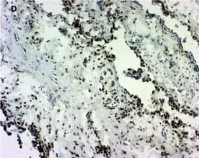 Immunohistochemistry: 15-PGDH/HPGD Antibody [NB200-179] - Expression of 15-prostaglandin dehydrogenase (15-PGDH) in healthy & inflamed synovial tissue. Immunohistochemical staining reveals positive (brown) staining for 15-PGDH (hematoxilin counterstained) in synovial tissue from healthy individuals (a) & patients with rheumatoid arthritis (b), osteoarthritis (c), or psoriatic arthritis (d). Original magnifications: ×250 (a, b), ×100 (c, d). Image collected & cropped by CiteAb from the following publication (//pubmed.ncbi.nlm.nih.gov/22616846), licensed under a CC-BY license. Not internally tested by Novus Biologicals.