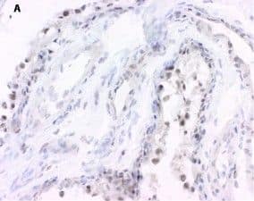 Immunohistochemistry: 15-PGDH/HPGD Antibody [NB200-179] - Expression of 15-prostaglandin dehydrogenase (15-PGDH) in healthy & inflamed synovial tissue. Immunohistochemical staining reveals positive (brown) staining for 15-PGDH (hematoxilin counterstained) in synovial tissue from healthy individuals (a) & patients with rheumatoid arthritis (b), osteoarthritis (c), or psoriatic arthritis (d). Original magnifications: ×250 (a, b), ×100 (c, d). Image collected & cropped by CiteAb from the following publication (//pubmed.ncbi.nlm.nih.gov/22616846), licensed under a CC-BY license. Not internally tested by Novus Biologicals.