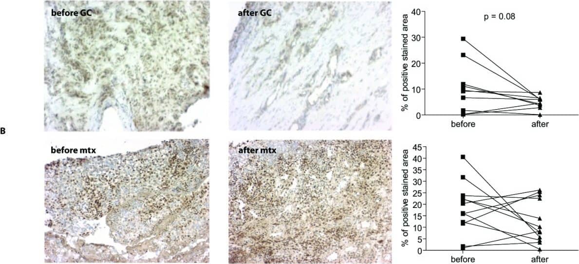 Immunohistochemistry: 15-PGDH/HPGD Antibody [NB200-179] - Cellular localization of 15-prostaglandin dehydrogenase (15-PGDH) in rheumatoid arthritis synovial tissue & the effects of anti-rheumatic treatment on its expression. (a) Double-immunofluorescence images show staining for 15-PGDH-positive (red) cells & cell marker staining (green) for macrophage CD163, fibroblast prolyl-4-hydroxylase, & endothelial cell CD31. Merged images display double-stained cells in yellow. Original magnification: ×400. Light microscopy pictures of representative synovial biopsy sections show immunohistochemical positive (brown) staining for 15-PGDH before & after intra-articular treatment with glucocorticoids (b) & before & 8 weeks after initiation of methotrexate therapy (c) (hematoxilin counterstained). Graphs display the comparative 15-PGDH expression in rheumatoid arthritis synovial tissue before & after treatment with glucocorticoids or methotrexate as a percentage of the positive stained area versus the total tissue area. GC, glucocorticoids; Mtx, methotrexate. Image collected & cropped by CiteAb from the following publication (//pubmed.ncbi.nlm.nih.gov/22616846), licensed under a CC-BY license. Not internally tested by Novus Biologicals.