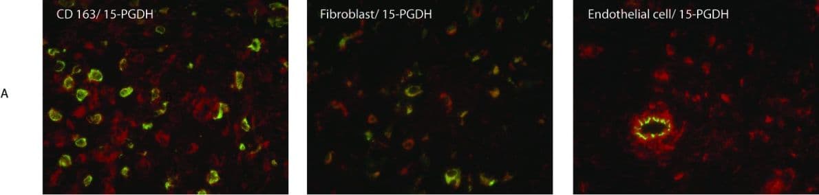 Immunocytochemistry/ Immunofluorescence: 15-PGDH/HPGD Antibody [NB200-179] - Cellular localization of 15-prostaglandin dehydrogenase (15-PGDH) in rheumatoid arthritis synovial tissue & the effects of anti-rheumatic treatment on its expression. (a) Double-immunofluorescence images show staining for 15-PGDH-positive (red) cells & cell marker staining (green) for macrophage CD163, fibroblast prolyl-4-hydroxylase, & endothelial cell CD31. Merged images display double-stained cells in yellow. Original magnification: ×400. Light microscopy pictures of representative synovial biopsy sections show immunohistochemical positive (brown) staining for 15-PGDH before & after intra-articular treatment with glucocorticoids (b) & before & 8 weeks after initiation of methotrexate therapy (c) (hematoxilin counterstained). Graphs display the comparative 15-PGDH expression in rheumatoid arthritis synovial tissue before & after treatment with glucocorticoids or methotrexate as a percentage of the positive stained area versus the total tissue area. GC, glucocorticoids; Mtx, methotrexate. Image collected & cropped by CiteAb from the following publication (//pubmed.ncbi.nlm.nih.gov/22616846), licensed under a CC-BY license. Not internally tested by Novus Biologicals.