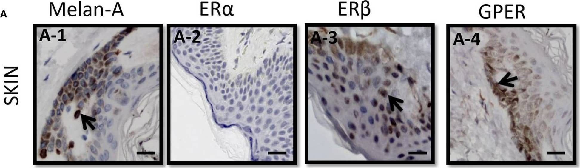 ERs expressions and the survival rates in melanoma patients. (A) Immunoshitochemical staining of Melanin (A–1), ER alpha  (A–2), ER beta  (A–3), and GPER (A–4) in skin (upper panel) (A–1–A–4) and (B) melanoma (lower panel) (B–1–B–4), where normal human skin serves as control. Arrows indicates the positive signals. Kaplan–Meier survival curves of the expression of ER alpha  (C,F), ER beta  (D,G), and GPER(E,H) in all patients from the Human Protein Atlas (C–E) and TCGA (F–H). Scale bar is 100 μm. Image collected and cropped by CiteAb from the following open publication (//pubmed.ncbi.nlm.nih.gov/31696058), licensed under a CC-BY license. Not internally tested by Novus Biologicals.
