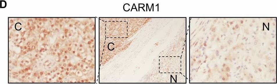 CARM1 is a downstream effector of PSMD14 that affects the prognosis of HCC patients.A CARM1 was transfected into HCC cells with PSMD14 knockdown. A CCK-8 assay was performed to detect proliferation. B CARM1 was transfected into HCC cells with PSMD14 knockdown. Then, a colony formation assay was conducted. C CARM1 was transfected into HCC cells with PSMD14 knockdown. Then, a transwell assay was performed to detect migration and invasion. Representative images of the transwell assay are shown. The cells in five randomly selected fields were counted under a microscope. D Representative images of immunohistochemical staining of PSMD14 and CARM1 in the same HCC and corresponding adjacent normal liver tissues are shown. E Correlation analysis of PSMD14 and CARM1 in HCC tissues. The data were statistically analyzed by the Chi-square test. R indicates the Pearson correlation coefficient. F Scatter diagram showing a positive correlation between PSMD14 and CARM1 in HCC tissues by IHC. G Survival analysis of HCC patients was conducted using Kaplan-Meier plots and log-rank tests. The patients were categorized into high and low PSMD14 and CARM1 expression groups based on IHC staining. (n = 3; *p < 0.05, **p < 0.01, and ***p < 0.001). Image collected and cropped by CiteAb from the following open publication (//pubmed.ncbi.nlm.nih.gov/40016178), licensed under a CC-BY license. Not internally tested by Novus Biologicals.