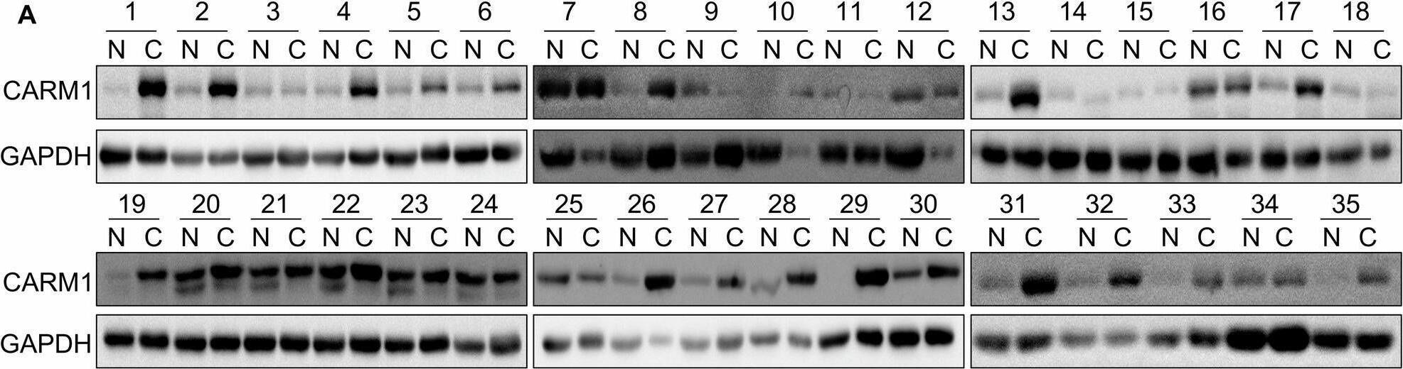 CARM1 is upregulated in HCC tissues and indicates poor clinical outcomes.A Western blotting analysis showed the expression of CARM1 in 35 pairs of HCC and adjacent normal liver tissues. B The expression of CARM1 in 66 pairs of HCC and corresponding adjacent normal liver tissues was examined via an IHC assay. C Kaplan-Meier survival analysis of overall survival in HCC patients stratified by CARM1 expression. Patients with low expression (n = 19) had lower expression values in HCC tissues than in normal tissues, while patients with high expression (n = 47) had higher expression values in HCC tissues than in normal tissues. D CARM1 mRNA levels in normal and primary HCC tumor tissues from the TCGA database. E Kaplan-Meier survival analysis of HCC patients from the TCGA database was performed according to CARM1 mRNA expression. Patients with high CARM1 expression had expression values in the >3rd quantile, while patients with low CARM1 expression had expression values in the <3rd quartile. Image collected and cropped by CiteAb from the following open publication (//pubmed.ncbi.nlm.nih.gov/40016178), licensed under a CC-BY license. Not internally tested by Novus Biologicals.