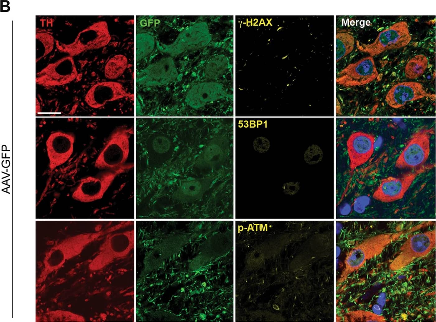 Immunocytochemistry/ Immunofluorescence: Tyrosine Hydroxylase Antibody [NB300-110] - Activation of the DDR in mice transduced with AAV2/6 h-syn.a h-syn expression increases 53BP1 &  gamma H2AX foci, & ATM phosphorylation in nigral dopaminergic neurons. b The DDR is not activated by viral delivery of GFP. Scale bar: 50 μm. (**p < 0.01; ***p < 0.001; Student’s t test). All bar graphs show mean + /− s.e.m Image collected & cropped by CiteAb from the following publication (//pubmed.ncbi.nlm.nih.gov/30050065), licensed under a CC-BY license. Not internally tested by Novus Biologicals.