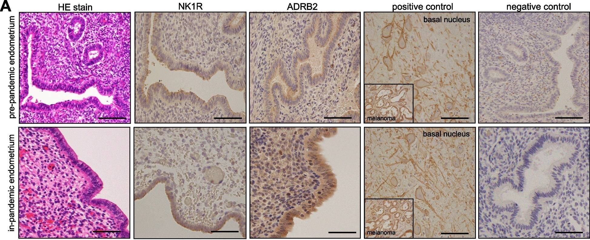 A An image of slides showing the hematoxyline eosin (HE)-stained and immunohistochemical analysis of neurokinin receptor 1 (NK1R)- and  beta 2-adrenergic receptor (ADRB2)-stained cells in the pre-pandemic (upper row) and in-pandemic endometria (lower row) with corresponding positive controls (basal nucleus, Meynert neurons of human brain tissue for NK1R and melanoma for ADRB2) and negative controls. The immunoreactivities of NK1R B and ADRB2 C are shown as measured by the immunoreactive score (IRS) in pre-pandemic and in-pandemic endometria. The procedure of IRS measurement is described in methods. Mann–Whitney U test indicated that while no significance difference in the endometrial expression of NK1R was observed between the groups, ADRB2 expression in the endometria was significantly higher in the in-pandemic group than that in pre-pandemic group (p = 0.015) (C). The boxes represent the interquartile ranges and horizontal lines in the boxes represent median values. Scale bar = 50 μm for each slide Image collected and cropped by CiteAb from the following open publication (//pubmed.ncbi.nlm.nih.gov/37142998), licensed under a CC-BY license. Not internally tested by Novus Biologicals.