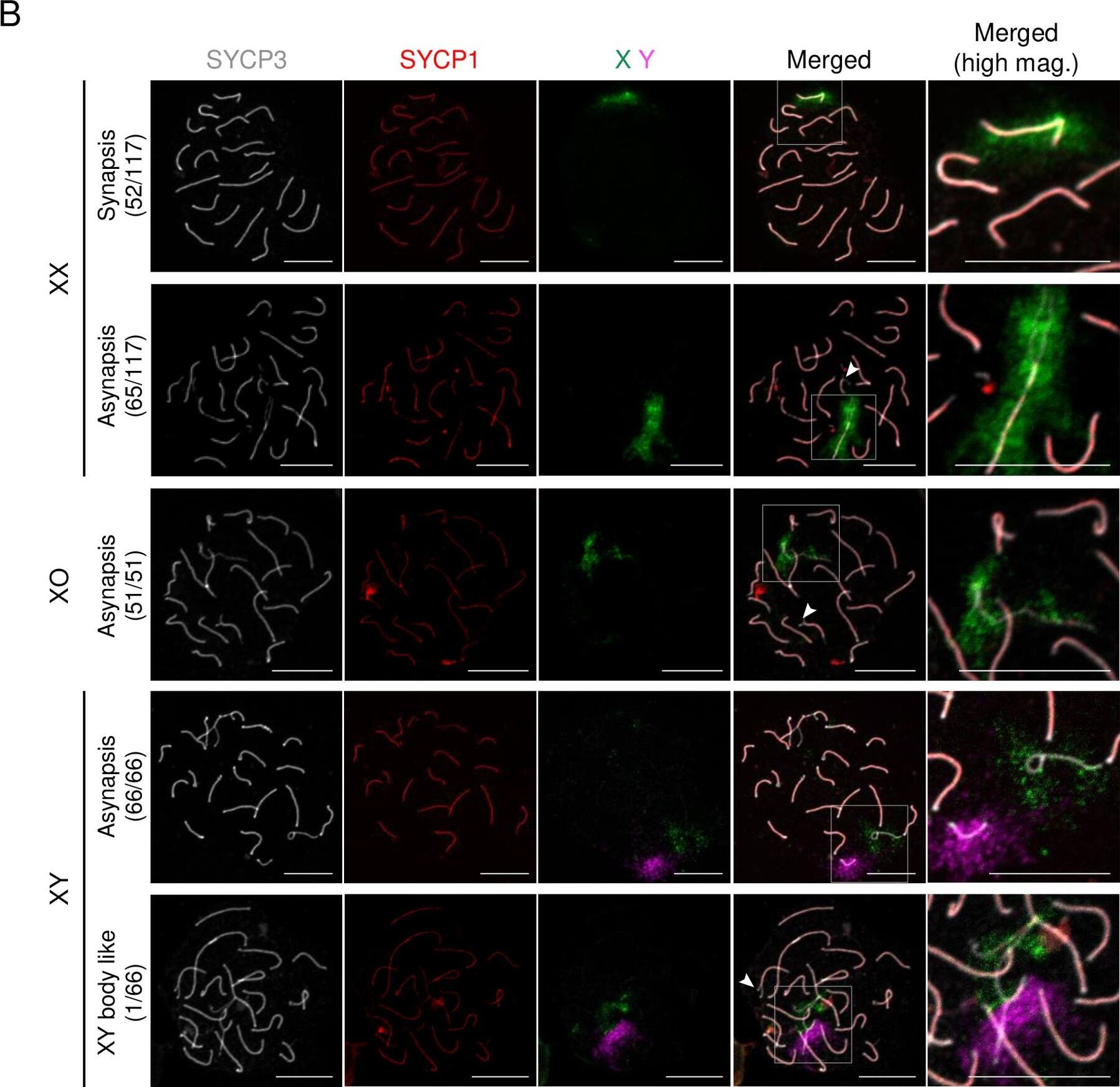 Immunocytochemistry/ Immunofluorescence: SCP1 Antibody - BSA Free [NB300-229] - Meiotic progression & chromosome paring in XX, XO & XY oocytes.(A) Meiotic progression in XX, XO & XY oocytes. The graphs show the percentages of the meiotic stage at the day of culture indicated. L, leptotene; Z, zygotene; P, pachytene; D, diplotene. (B) Pairing of homologous chromosomes in XX, XO & XY oocytes. Images show the immunofluorescence analysis of SYCP3 (white) & SYCP1 (red), & FISH analysis of the X chromosome (green) & Y chromosome (purple). The dashed squares in the merged images are shown at high magnification (right). The numbers of samples showing the phenotype are shown with the total number tested (left). Arrowheads indicate asynapsed bivalents at the end of the chromosomes. Scale bars, 10 μm. (C) Pairing rates of autosomes & sex chromosomes. Each value was calculated from three independent experiments (see also Materials & Methods). P values were calculated by Tukey’s HSD test. ***P<0.001, **P<0.01, *P<0.05; NS, not significant. Image collected & cropped by CiteAb from the following publication (//pubmed.ncbi.nlm.nih.gov/32214314), licensed under a CC-BY license. Not internally tested by Novus Biologicals.