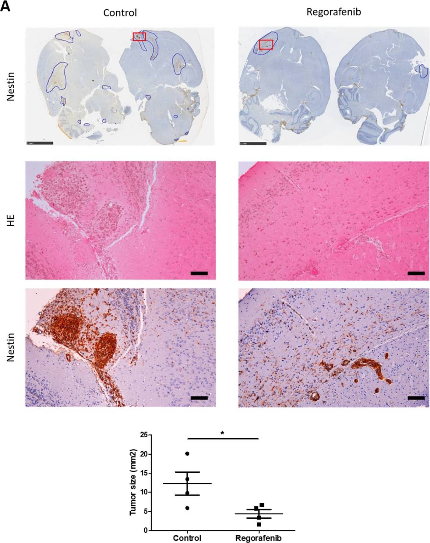 Immunohistochemistry: Nestin Antibody (10C2) - BSA Free [NB300-266] - Regorafenib inhibits tumour growth & vascularisation in xenograft mice. GC1 were implanted into the right forebrain of mice. The mice then received daily oral vehicle or regorafenib at 30 mg/kg for 45 days. (A) Representative photographs of mice brain tumours treated with regorafenib (right panel) or without regorafenib (left panel) stained by hemalun–eosin (median panel) or with nestin antibody (upper & lower panel). The upper panel shows whole brains of mice stained with nestin antibody. The tumour areas were circled in blue, & each surface was measured in mm2. The red rectangles indicate the zone of the tumour shown in median (hemalun–eosin staining) & lower (nestin IHC) panel. Scale bars, upper panel 2.5 mm, median & lower panel 100 µm. The graph shows the tumour size in mm2 (expressed as the mean ± SEM of 4 mice). (B) Representative immunohistochemistry photographs of CD31+ vessels in brain tumour areas of 3 different mice treated with regorafenib (right panel) or without regorafenib (control, left panel). Arrows indicate CD31+ blood vessels. Scale bars, 20 µm. The graph shows the number of CD31+ vessels in tumours per mm2 (expressed as mean ± SEM of 4 mice). * p < 0.05. Image collected & cropped by CiteAb from the following publication (//pubmed.ncbi.nlm.nih.gov/35326702), licensed under a CC-BY license. Not internally tested by Novus Biologicals.