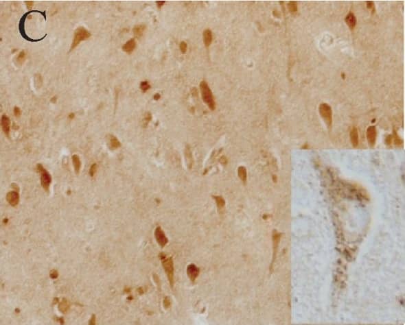 Immunohistochemistry-Paraffin: LRRK2 Antibody - BSA Free [NB300-268] - Immunocytochemistry of LRRK2 in DLB. Cortical LBs (arrows) in DLB were positive for LRRK2 using both Ab4 against LRRK22500–2527 (A), & Ab1 against LRRK2900–100 (B). Neuronal cytoplasm (C) was also strongly labelled throughout the cortex by Ab4 & with a consistently more granular pattern by Ab1 (inset in C) in cases of DLB. Control cases display similar, though less intense neuronal labeling (D). Biochemically purified cortical LBs were strongly positive for staining by Ab4 (E) as well as by anti-alpha -synuclein (F), while they were unstained when omitting primary antibody (G). Large vessels (H) were also intensely labelled by Ab4. Scale bars: A, B = 25 μm; C, D = 100 μm; E-G = 25 μm; H = 50 μm. Image collected & cropped by CiteAb from the following publication (//pubmed.ncbi.nlm.nih.gov/17137507), licensed under a CC-BY license. Not internally tested by Novus Biologicals.