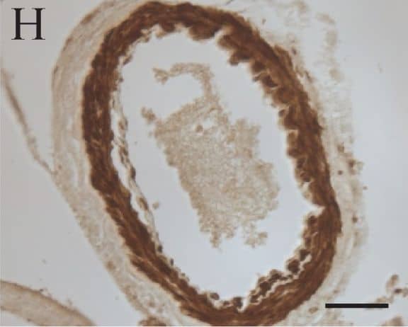 Immunohistochemistry-Paraffin: LRRK2 Antibody - BSA Free [NB300-268] - Immunocytochemistry of LRRK2 in DLB. Cortical LBs (arrows) in DLB were positive for LRRK2 using both Ab4 against LRRK22500–2527 (A), & Ab1 against LRRK2900–100 (B). Neuronal cytoplasm (C) was also strongly labelled throughout the cortex by Ab4 & with a consistently more granular pattern by Ab1 (inset in C) in cases of DLB. Control cases display similar, though less intense neuronal labeling (D). Biochemically purified cortical LBs were strongly positive for staining by Ab4 (E) as well as by anti-alpha -synuclein (F), while they were unstained when omitting primary antibody (G). Large vessels (H) were also intensely labelled by Ab4. Scale bars: A, B = 25 μm; C, D = 100 μm; E-G = 25 μm; H = 50 μm. Image collected & cropped by CiteAb from the following publication (//pubmed.ncbi.nlm.nih.gov/17137507), licensed under a CC-BY license. Not internally tested by Novus Biologicals.