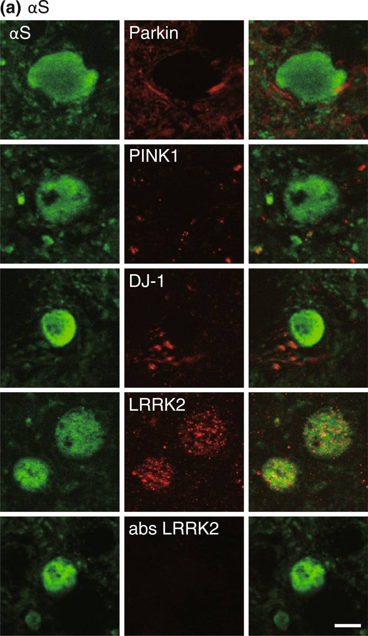 Immunocytochemistry/ Immunofluorescence: LRRK2 Antibody - BSA Free [NB300-268] - LRRK2 accumulates in globules in  alpha S tg mice. (a & b) Double immunofluorescence for  alpha S with parkin, PINK1, DJ-1, LRRK2, or negative control (the immunopeptide-preabsorbed anti-LRRK2 antibody) in  alpha S tg mice (a) & P123H  beta S tg mice (b). Note that  alpha S-globules were immunopositive for LRRK2 (~79%, n = 22), whereas P123H  beta S globules were negative for LRRK2. Representative images are shown for the thalamus ( alpha S) & basal ganglia (P123H  beta S). Scale bar = 5 μm for all panels. (c) Triple immunofluorescence for  alpha S, LRRK2 & Rab5B for basal ganglia in  alpha S tg mice. LRRK2 & Rab5B were colocalized in axon terminal (arrow), but were not colocalized in the  alpha S-globule (arrowhead) Scale bar = 10 μm for all panels. Image collected & cropped by CiteAb from the following publication (//molecularbrain.biomedcentral.com/articles/10.1186/1756-6606-5-34), licensed under a CC-BY license. Not internally tested by Novus Biologicals.