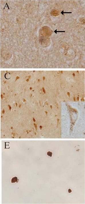 Immunohistochemistry-Paraffin: LRRK2 Antibody - BSA Free [NB300-268] - Immunocytochemistry of LRRK2 in DLB. Cortical LBs (arrows) in DLB were positive for LRRK2 using both Ab4 against LRRK22500–2527 (A), & Ab1 against LRRK2900–100 (B). Neuronal cytoplasm (C) was also strongly labelled throughout the cortex by Ab4 & with a consistently more granular pattern by Ab1 (inset in C) in cases of DLB. Control cases display similar, though less intense neuronal labeling (D). Biochemically purified cortical LBs were strongly positive for staining by Ab4 (E) as well as by anti-alpha -synuclein (F), while they were unstained when omitting primary antibody (G). Large vessels (H) were also intensely labelled by Ab4. Scale bars: A, B = 25 μm; C, D = 100 μm; E-G = 25 μm; H = 50 μm. Image collected & cropped by CiteAb from the following publication (//pubmed.ncbi.nlm.nih.gov/17137507), licensed under a CC-BY license. Not internally tested by Novus Biologicals.