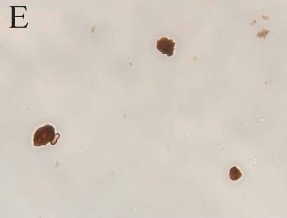 Immunohistochemistry-Paraffin: LRRK2 Antibody - BSA Free [NB300-268] - Immunocytochemistry of LRRK2 in DLB. Cortical LBs (arrows) in DLB were positive for LRRK2 using both Ab4 against LRRK22500–2527 (A), & Ab1 against LRRK2900–100 (B). Neuronal cytoplasm (C) was also strongly labelled throughout the cortex by Ab4 & with a consistently more granular pattern by Ab1 (inset in C) in cases of DLB. Control cases display similar, though less intense neuronal labeling (D). Biochemically purified cortical LBs were strongly positive for staining by Ab4 (E) as well as by anti-alpha -synuclein (F), while they were unstained when omitting primary antibody (G). Large vessels (H) were also intensely labelled by Ab4. Scale bars: A, B = 25 μm; C, D = 100 μm; E-G = 25 μm; H = 50 μm. Image collected & cropped by CiteAb from the following publication (//pubmed.ncbi.nlm.nih.gov/17137507), licensed under a CC-BY license. Not internally tested by Novus Biologicals.