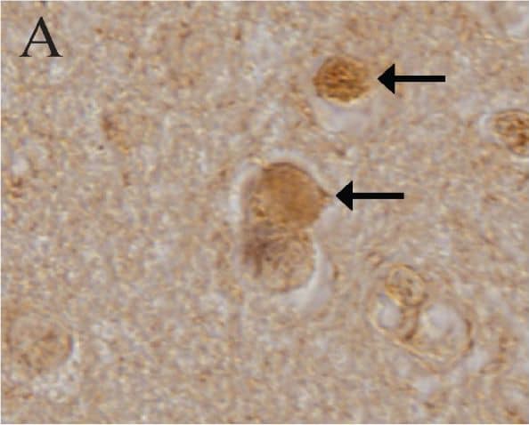 Immunohistochemistry-Paraffin: LRRK2 Antibody - BSA Free [NB300-268] - Immunocytochemistry of LRRK2 in DLB. Cortical LBs (arrows) in DLB were positive for LRRK2 using both Ab4 against LRRK22500–2527 (A), & Ab1 against LRRK2900–100 (B). Neuronal cytoplasm (C) was also strongly labelled throughout the cortex by Ab4 & with a consistently more granular pattern by Ab1 (inset in C) in cases of DLB. Control cases display similar, though less intense neuronal labeling (D). Biochemically purified cortical LBs were strongly positive for staining by Ab4 (E) as well as by anti-alpha -synuclein (F), while they were unstained when omitting primary antibody (G). Large vessels (H) were also intensely labelled by Ab4. Scale bars: A, B = 25 μm; C, D = 100 μm; E-G = 25 μm; H = 50 μm. Image collected & cropped by CiteAb from the following publication (//pubmed.ncbi.nlm.nih.gov/17137507), licensed under a CC-BY license. Not internally tested by Novus Biologicals.