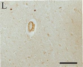 Immunohistochemistry-Paraffin: LRRK2 Antibody - BSA Free [NB300-268] - Immunocytochemistry of LRRK2 in PD. Four antibodies raised against sequences corresponding to various regions shown on the schematic diagram of LRRK2 (red bars) were used on brainstem sections of PD (A-H) & age-matched controls (I-L). Intense immunolabeling of brainstem LBs in cases of PD was seen with Ab1 against LRRK2900–100 (A) & Ab4 against LRRK22500–2527(D). Both rim (A & D) & core (inset in D) of LBs were recognized. In contrast, LBs were not labelled in any case using antibodies directed against LRRK21246–1265 (Ab2, B) or LRRK21838–2133 (Ab3, C), for which the antigenic sites are located within the folded domains. The cell bodies of both pigmented & no-pigmented neurons (arrows) as well as axons (arrowheads) contain LRRK2, seen only using antibodies against sites outside the folded domains (Ab1, E & Ab4, H). In contrast, Ab4 staining was much less intense in control tissue (L). The muscle layer of both large & small vessels was consistently found to contain high levels of LRRK2 in almost all PD cases (seen in E, G, & H) & strikingly the vessels are the only structure immunolabeled with Ab3 recognizing LRRK21838–2133 in all cases studied (G & K). Ab2 to LRRK21246–1265 did not recognize LBs, cell bodies or vessels in any case (B, F, & J). Scale bars: A-D & inset = 10 μm; E-L = 100 μm. Image collected & cropped by CiteAb from the following publication (//pubmed.ncbi.nlm.nih.gov/17137507), licensed under a CC-BY license. Not internally tested by Novus Biologicals.