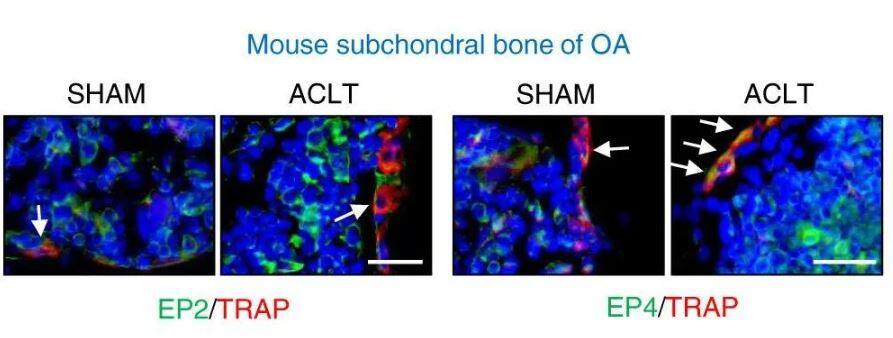 Immunohistochemistry: TRAP1 Antibody (TRAP1-6) [NB300-555] - Representative images of IHF staining of EP2 or EP4 (green) and TRAP1 (NB300-555) (red) in subchondral bone 2 weeks post-sham or ACLT surgery (left) and quantitative analysis (right). The white arrows indicate TRAP-positive osteoclasts expressing EP2 or EP4. Scale bars, 20 um. Image collected and cropped by CiteAb from the following publication (//pubmed.ncbi.nlm.nih.gov/35260562/) licensed under a CC-BY license.