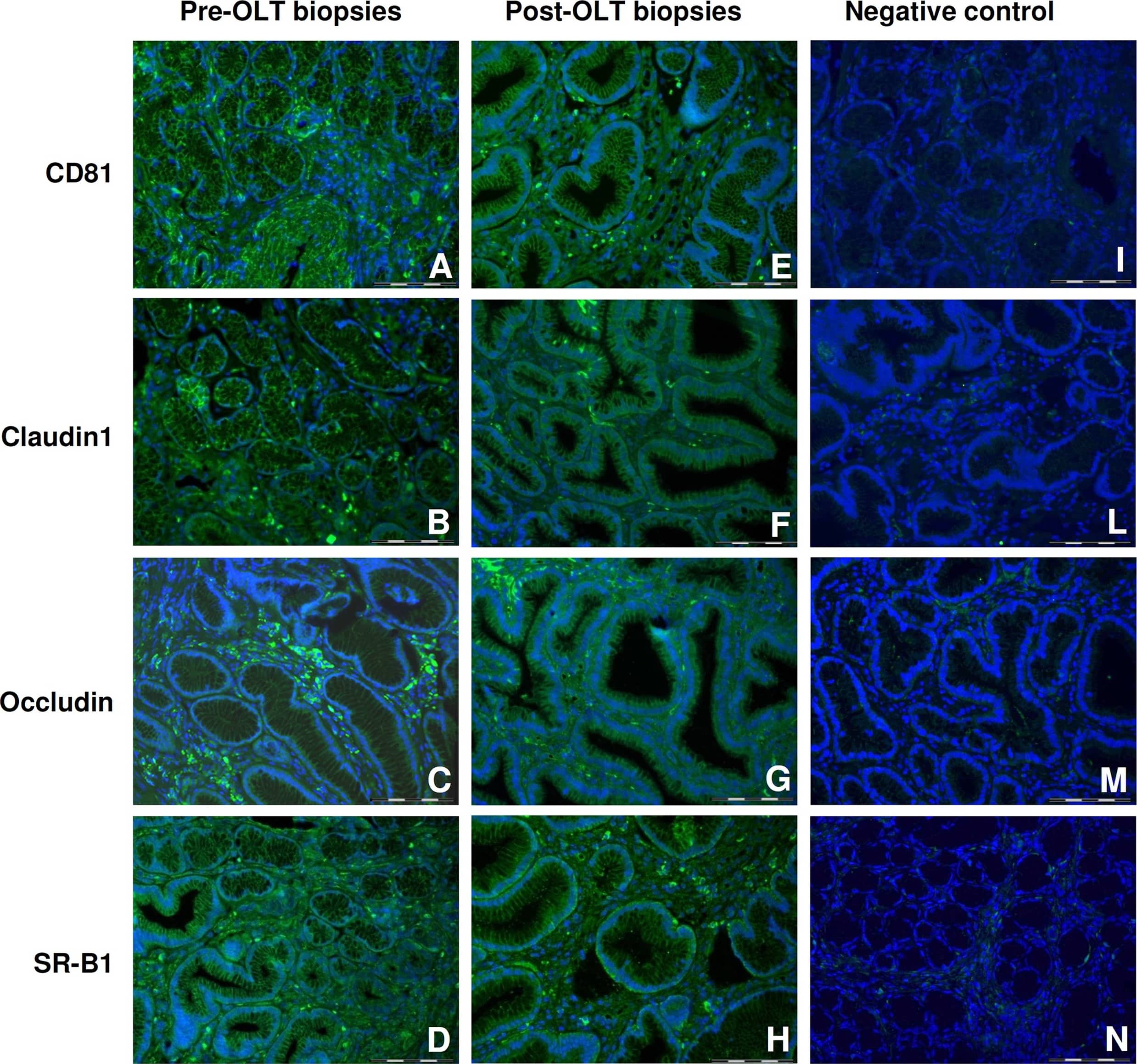 Immunocytochemistry/ Immunofluorescence: SR-BI Antibody - BSA Free [NB400-104] - Immunofluorescence assay on GIM biopsies of HCV-transplanted patients.Immunofluorescence assay on GIM polyp biopsies of HCV-transplanted patients, using antibodies against HCV receptors: CD81, SR-B1, Claudin-1, Occludin (Original magnification X400). (A, E) CD81 in colon (patient 26); (B, F) Claudin-1 in colon (patient 26); (C, G) Occludin in colon (C patient 28, G patient 26); (D) SR-B1 in antrum (patient 28); (H) SR-B1 in colon (patient 26). All the sections were clearly positive for the analyzed HCV receptors before (A-D) & after transplantation (E-H). Negative controls (I-N) were performed on GIM biopsies of HCV positive patients by omitting the primary antibodies, & by using polyclonal FITC-conjugated Donkey anti-mouse (I) & anti-rabbit (L, M, N) as secondary antibodies. (I CD81 in antrum; L Claudin-1 in polyp colon; M Occludin in antrum; N SR-B1 in polyp colon. Nuclei were counterstained with DAPI (blue). Scale bar 50 μm. Image collected & cropped by CiteAb from the following publication (//dx.plos.org/10.1371/journal.pone.0181683), licensed under a CC-BY license. Not internally tested by Novus Biologicals.