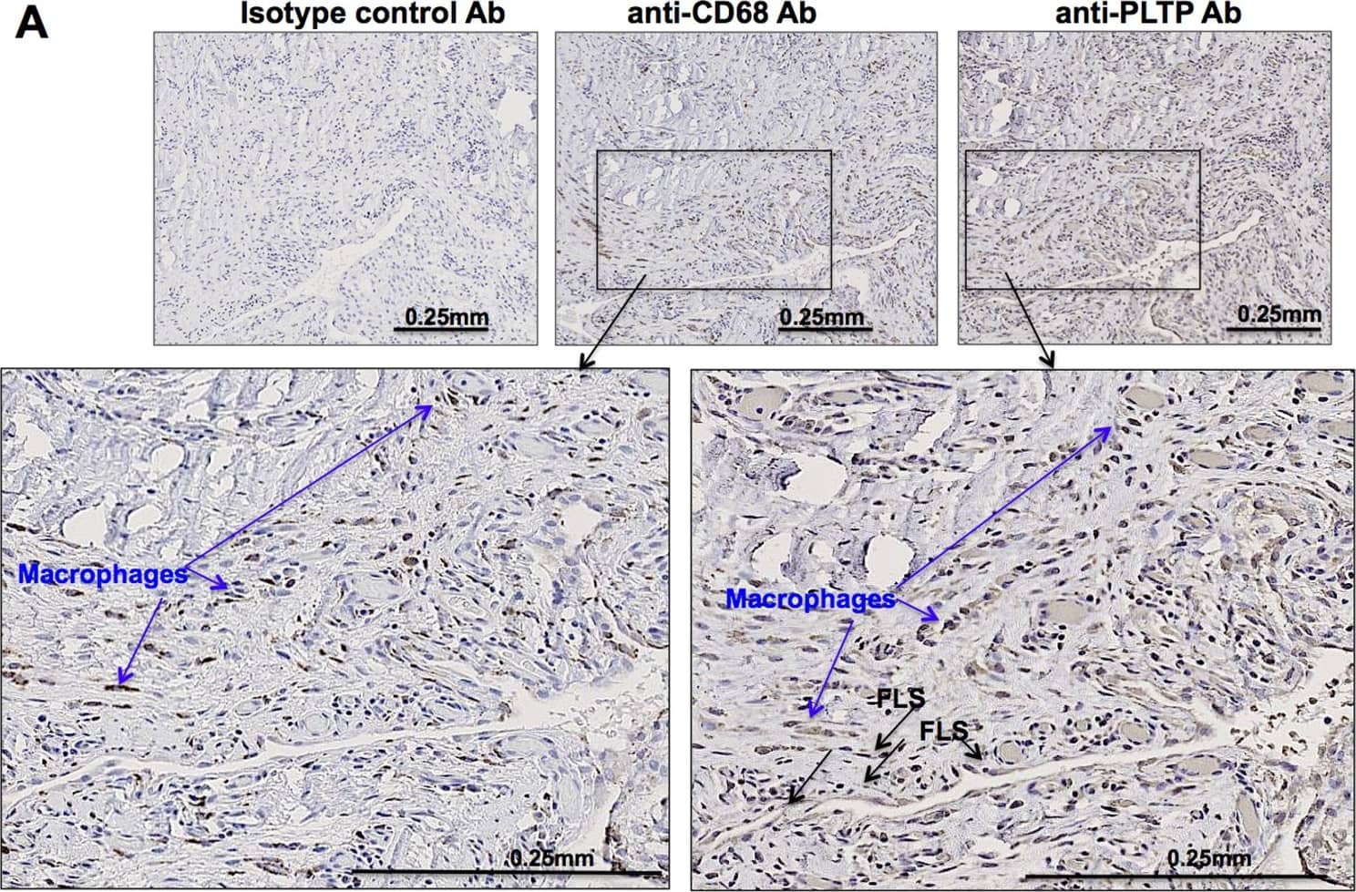 Immunohistochemistry: PLTP Antibody [NB400-106] - PLTP expression in RA synovial tissues.For immuno-histological analysis, (A) synovial tissue sections from RA patients (n = 5) were stained for PLTP or macrophages (CD68+ cells). Representative images obtained for immunohistological staining are shown. Blue arrows show macrophages (non-exhaustive), determined as CD68+ cells. FLS are determined with morphological features & CD68+ staining (black arrow; non-exhaustive). (B, C) Double staining was performed to visualize localization (n = 3) of PLTP with macrophages (CD68+) (B) or RA-FLS ( alpha -SMA+) (C). Fluorescence was analyzed at 20x magnification. Overlay is shown to visualize co-localization of PLTP in macrophages (CD68+) (B) or RA-FLS ( alpha -SMA+) (C) or PLTP expression in infiltrate. Original magnification: 20x. Separate images can be found in S1 Fig. Image collected & cropped by CiteAb from the following publication (//dx.plos.org/10.1371/journal.pone.0193815), licensed under a CC-BY license. Not internally tested by Novus Biologicals.