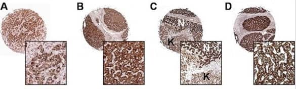 Immunohistochemistry: Survivin Antibody - BSA Free [NB500-201] - Protein expression pattern of Survivin, XIAP & XAF1 in HCC tissues & non-neoplastic liver parenchyma. IAP members immunoreactivity was estimated by tissue microarray in a subset of HCC patients (n = 40). A-D, Representative Survivin cytoplasmatic immunostaining in a tumor core (A), in a tumor proximal to cirrhosis (C, N: cirrhosis, K: HCC), & in adjacent & long-distance non-neoplastic parenchyma (B & D, respectively). XIAP marked (score 12) & moderate (score 8) immunoreactivity is shown for HCC (E & I, respectively) as well as for cirrhosis (F & L, respectively). G & H, Nuclear XAF1 staining is shown for tumor & non-neoplastic liver whereas XAF1 cytoplasmatic expression in HCC & cirrhosis is shown in panels M & N, respectively. Original magnification ×50 & ×250, for tissue cores & insets, respectively. Image collected & cropped by CiteAb from the following publication (//bmccancer.biomedcentral.com/articles/10.1186/1471-2407-9-125), licensed under a CC-BY license. Not internally tested by Novus Biologicals.