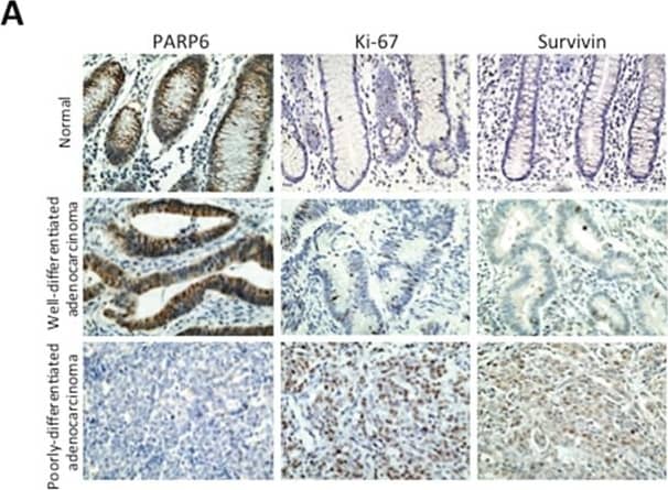 Western Blot: Survivin Antibody - BSA Free [NB500-201] - Correlation between PARP6 & Survivin expression in CRCA. Expression of PAPR6 & Survivin in 238 CRC cases was examined by immunohistochemistry. Representative images of PARP6, Ki-67 & Survivin in normal colonic mucosa, well differentiated adenocarcinoma & poorly differentiated adenocarcinoma cases. B. Correlation between PARP6 & proliferation marker, Ki-67 in CRC cases by immunohistochemistry. Graph shows Ki-67 index in CRC cases with low or high expression of PARP6. C. Correlation between PARP6 & Survivin in CRC cases by immunohistochemistry. Graph shows Ki-67 index in CRC cases with low or high expression of Survivin. D. The expression of PAPR6 & Survivin were determined in 4 CRC tissues & normal adjacent colorectal tissues by Western blot analysis.  beta -actin was used as a loading control. Image collected & cropped by CiteAb from the following publication (//pubmed.ncbi.nlm.nih.gov/26934315), licensed under a CC-BY license. Not internally tested by Novus Biologicals.