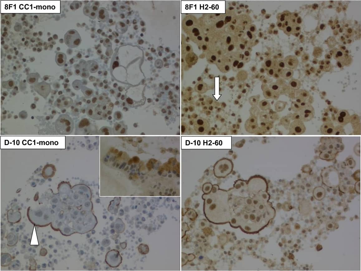 Immunohistochemistry: ERCC1 Antibody (8F1) - BSA Free [NB500-704] - Anti-ERCC1 immunocytochemistry on cell block core of malignant pleural mesothelioma, using Mab 8F1 & D-10 with CC1-mono & H2-60 protocols. Arrow: Surrounding non-tumoral cells, including lymphocytes, macrophages & neutrophil granulocytes. Arrowhead: Unspecific plasma membrane staining with D-10. 200 × original magnification. Inset lower left: Staining of intracellular mucin vacuoles of a mucinous adenocarcinoma of unknown origin. 400 × original magnification. Image collected & cropped by CiteAb from the following publication (//jclinbioinformatics.biomedcentral.com/articles/10.1186/2043-9113-1-25), licensed under a CC-BY license. Not internally tested by Novus Biologicals.