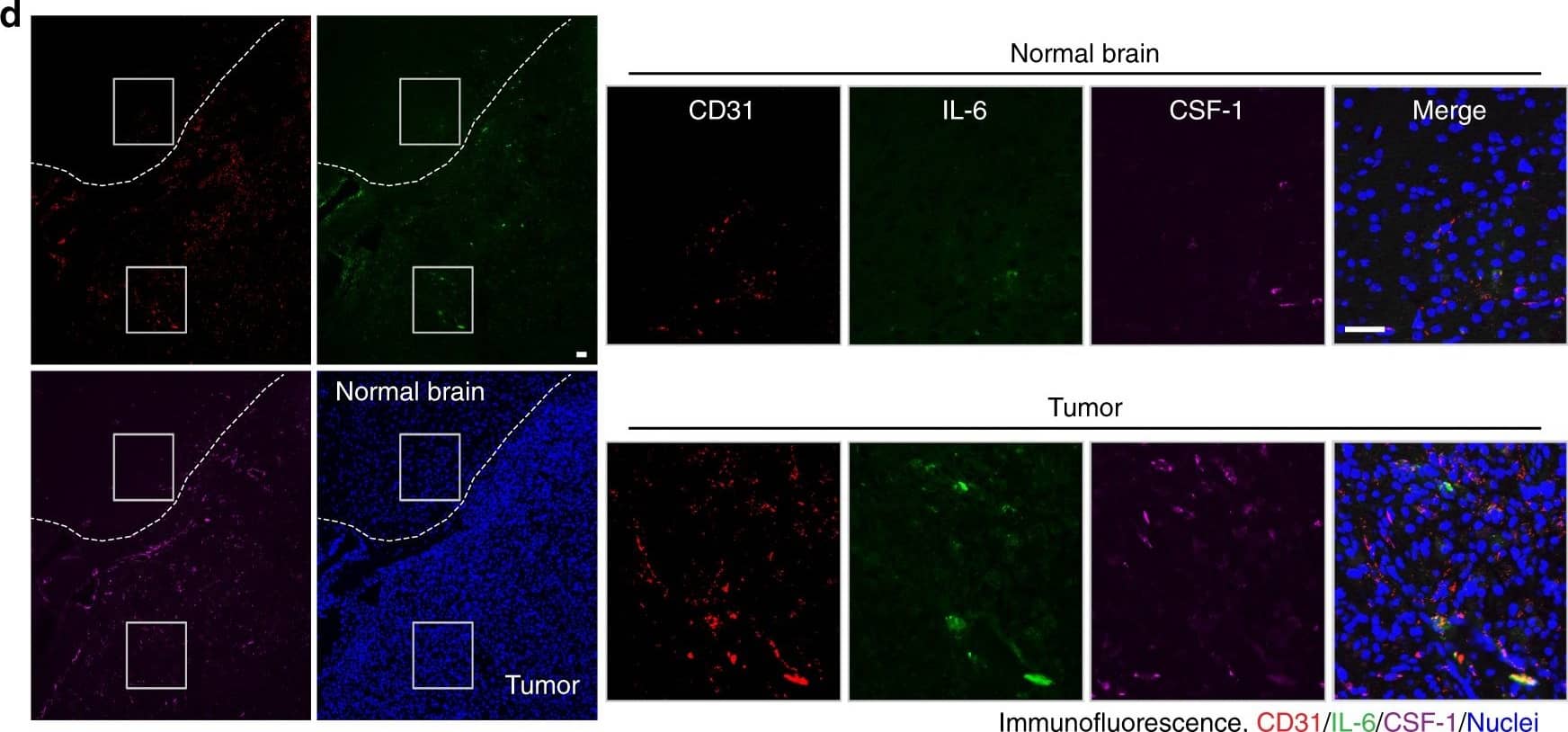 Immunocytochemistry/ Immunofluorescence: IL-6 Antibody [NB600-1131] - GBM ECs express IL-6. a Human brain ECs were treated with glioma-CM for 24 h, & cell lysates were subjected to multiplex cytokine array analysis. Left, a representative blot. Right, quantified dot intensity of most significantly changed cytokines. b Human microvascular brain ECs were treated with glioma-CM that were harvested from different human glioma cells. Cell lysates were immunoblotted. c Human microvascular brain ECs & tumor-associated ECs isolated from different GBM patients were subjected to immunoblot analysis. d Mouse GBM was induced by orthotopic injection of GL26 glioma cells into wild-type mouse. The brain sections that include normal brains & tumors were stained with anti-CD31, anti-IL-6, & anti-CSF-1 antibodies. Representative immunofluorescence images are shown. Right, enlarged area in normal & tumor tissues. Bar represents 50 μm. Zoom-in factor: 4 Image collected & cropped by CiteAb from the following publication (//pubmed.ncbi.nlm.nih.gov/29422647), licensed under a CC-BY license. Not internally tested by Novus Biologicals.