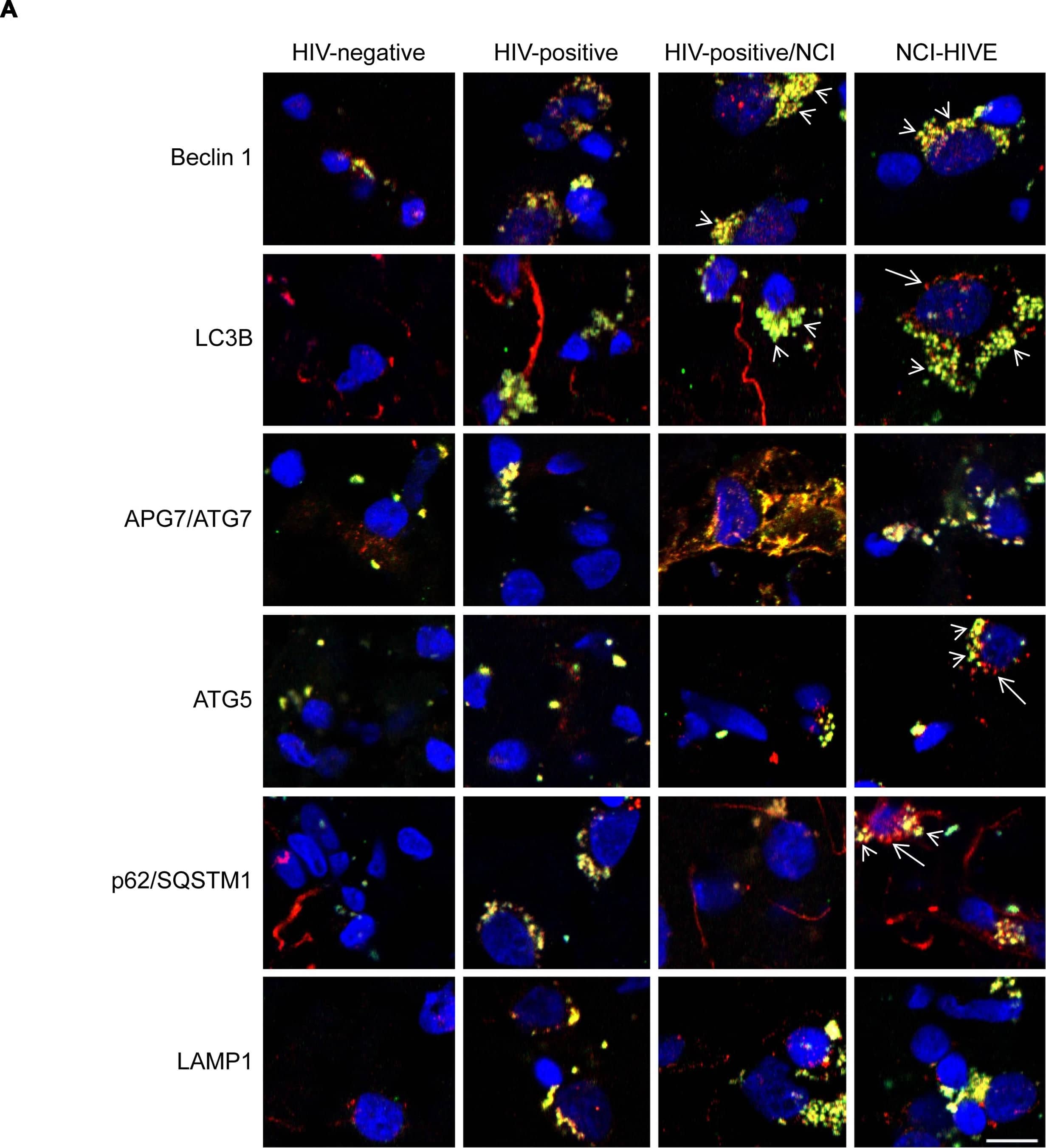 Autophagy associated protein immunoreactivity in HIV-infected brain tissue. (A) Representative images from five randomly selected fields of cells each examined in duplicate frontal lobe white matter sections for the indicated subject groups. The indicated proteins were labeled red & microglia with the cell-type-specific marker Iba1 (green). Blue staining indicates cell nuclei. Arrow heads indicate examples of higher Iba1 immunoreactivity whereas arrows indicate more focal (punctal) vs. diffuse (filamentous) patterns of autophagy associated protein expression. Scale bar = 10 μm. (B) Quantification of relative Iba1 immunoreactivity from (A). F(3,20) = 6.450, p = 0.0031; ∗p < 0.05 when compared to all other subject groups. Error bars show the SEM for the average values of 2–6 regions from each subject group across the six autophagy associated proteins examined. (C) Quantification of the indicated autophagy associated protein relative immunoreactivity from (A). Beclin 1: F(3,12) = 11.29, p = 0.0008; LC3B: F(3,12) = 1.994, p = 0.1687; APG7/ATG7: F(3,12) = 84.20, p = < 0.0001; ATG5: F(3,12) = 6.218, p = 0.0086; p62/SQSTM1: F(3,12) = 87.04, p = < 0.0001; LAMP1: F(3,12) = 8.317, p = 0.0029. ∗p < 0.05 when compared to HIV-negative; #p < 0.05 when compared to HIV-positive; & Ωp < 0.05 when compared to HIV-positive/NCI subjects. Error bars show the SEM for four regions from each subject group. Image collected & cropped by CiteAb from the following publication (//journal.frontiersin.org/Article/10.3389/fmicb.2015.00653/abstract), licensed under a CC-BY license. Not internally tested by Novus Biologicals.
