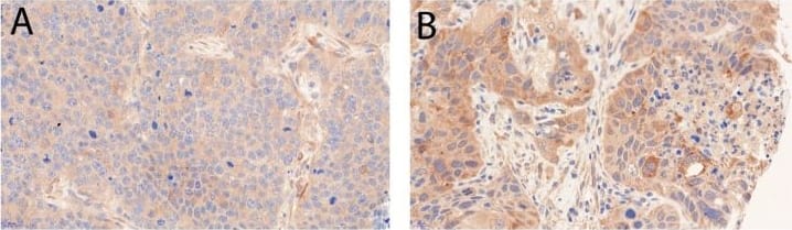 Immunohistochemistry: LC3B Antibody - BSA Free [NB600-1384] - Examples of immunohistochemical stainings; (A) LC3B low, (B) LC3B high, (C) p62 low (any cellular compartment), (D) p62 cytoplasmic low, (E) p62 cytoplasmic/dot like high, nuclear low, (F) p62 cytoplasmic/dot like low, nuclear high, (G) HMGB1 low, (H) HMGB1 high. Objective magnification, 40×. Image collected & cropped by CiteAb from the following publication (//pubmed.ncbi.nlm.nih.gov/30134604), licensed under a CC-BY license. Not internally tested by Novus Biologicals.