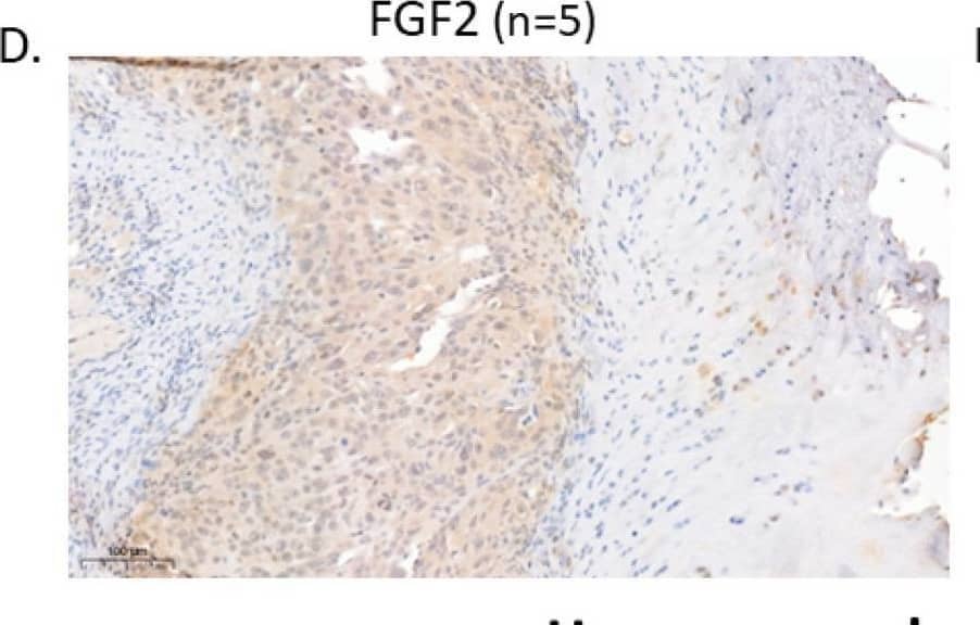 High VEGF-A and FGF2 labeling levels in an orthotopic OS mouse model and in human lung metastasis specimens: (A) U2-OS tumor image at 5 weeks and (B) anti-VEGF-A immunolabeling. Representative images of primary OS tumors in mice and nearby bone. The labeling pattern was mainly cytoplasmic; however, nuclear labeling was also noticed. Images were obtained under a ×40 magnification. Scale bar denotes 50 um. (C) Quantitative analysis of immunolabeled area (tumor/bone ratio) of primary OS tumors in mice normalized to nearby bone. Primary OS tumors exhibit significantly higher VEGF-A levels compared to control bone; *** p < 0.001. (D) FGF2 immunolabeling. Representative images of primary OS tumors in mice and nearby bone. Images were obtained under ×40 magnification. Scale bar denotes 50 um. (E) Quantitative analysis of immunolabeled area (tumor/bone ratio) of primary OS tumors in mice normalized to nearby bone. Primary OS tumors exhibit significantly higher FGF2 levels compared to control bone; ** p < 0.01. (F) Representative anti-VEGF-A and anti-FGF2 immunolabeling of human metastatic OS and non-metastatic OS patient specimens. Images showing nuclear labeling pattern. Microscope images were obtained under ×40 magnification. Scale bar denotes 50 um. (G) Quantitative analysis of immunolabeled area (1/um2) in metastatic vs. non-metastatic human OS specimens. Higher levels of VEGF-A (primary, N = 7; metastasis, N = 8) and FGF2 (primary, N = 6; metastasis, N = 14) were obtained in metastatic samples compared to primary tumors; * p < 0.05, and **** p < 0.0001. Image collected and cropped by CiteAb from the following open publication (//www.mdpi.com/2072-6694/15/6/1818), licensed under a CC-BY license. Not internally tested by Novus Biologicals.
