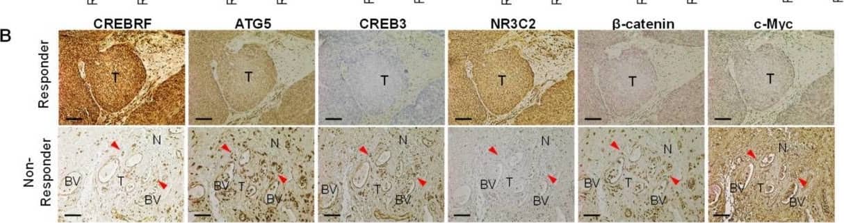 Downregulation of CREBRF and NR3C2 increase poor prognosis in HNSCC. (A) Histological analysis of miR124-3p and miR766-3p target gene expression (CREBRF-ATG5/CREB3, NR3C2-beta -catenin/c-Myc) in Responder vs. Non-Responder HNSCC clinical samples. Magnification, x100. Scale bar, 210 um. The quantitative data from all specimens are shown in the bar chart. Each dot in the graph represents an individual clinical sample. Two-sided unpaired Student t test was used to analyze comparisons, and data are presented as means +/- SEM. * p < 0.05 and *** p < 0.001. (B) Histological analysis of tumor morphology in relation to miR124-3p and miR766-3p target gene expression. Representative images of CREBRF, ATG5, CREB3, NR3C2,  beta -catenin, and c-Myc expression in the serial section of responder and non-responder HNSCC specimens. BV: Blood Vessel. T: Tumor. N: Normal tissue. The invasive cancer cells are indicated by red arrowhead. Magnification, ×200. Scale bar, 100 um. (C) Summary of resistance mechanisms regulated by miR124-3p and miR766-3p. Our data indicated that upon acquired resistance in HNSCC cells or in non-responder HNSCC tumors, the levels of miR124-3p and miR766-3p go up, which in turn down-regulate its direct target genes: CREBRF and NR3C2, and consequently the expression of downstream targets of CREBRF (ATG5/CREB3) and NR3C2 ( beta -catenin/c-Myc) increased in resistant tumors, which are positively correlated with poor prognosis. Thus, by enhancing the CREBRF-ATG5/CREB3 and NR3C2-beta -catenin/c-Myc axis, miR124-3p and miR766-3p support aggressive HNSCC progression. Image collected and cropped by CiteAb from the following open publication (//pubmed.ncbi.nlm.nih.gov/36358691), licensed under a CC-BY license. Not internally tested by Novus Biologicals.