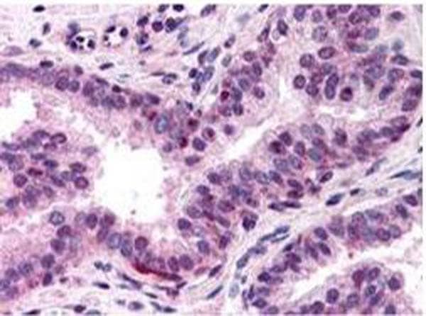 Immunohistochemistry of Rabbit anti-NF-Y (A Subunit) antibody. Tissue: human prostate tissue.   Fixation: formalin fixed paraffin embedded.  Antigen retrieval: not required. Primary antibody: NF-Y antibody at 10 ug/mL for 1 h at RT. Secondary antibody: Peroxidase rabbit secondary antibody at 1:10,000 for 45 min at RT. Localization: NF-Y is nuclear. Staining: NF-Y subunit A as precipitated red signal with hematoxylin purple nuclear counterstain.