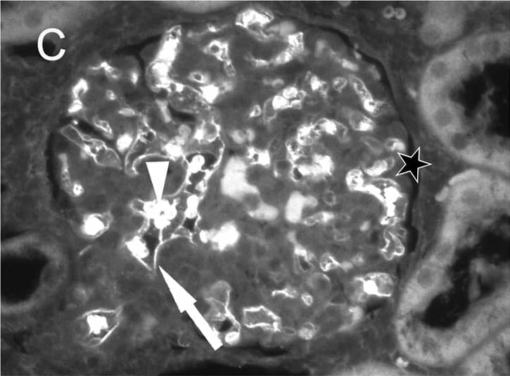 Immunohistochemistry: Goat anti-Human IgG Fc Secondary Antibody [NB7446] - Immune fluorescent photomicrographs of glomeruli from control (A), aflibercept-treated (B–D) & ranibizumab-treated (E–F) monkeys eyes.In all figures, the asterisks label the spaces of the Bowman capsule. A) Kidney sections from the control animal did not show any specific staining with anti-human IgG-Fc antibody in the glomeruli. Only the erythrocytes (arrow) within the capillaries showed a weak fluorescence. B) One day after aflibercept injection, the endothelium cell layer & material within the capillaries of a glomerulus were highly fluorescent (white arrow) after labelling with an antibody against the Fc region of IgG. In an adjacent glomerulus, only the endothelium was stained (white arrowhead) whereas the lumina of the vessels did not contain IgG-Fc positive material (black arrow). C) Erythrocytes within the glomeruli (arrowhead) as well as the endothelium (arrow) were highly fluorescent. D) Seven days after aflibercept injection, the fluorescent material within the capillaries (arrowhead) & the fluorescence intensity of the endothelium became weaker. E) One day after ranibizumab injection, the endothelium cell layer (white arrow) & erythrocytes (arrowhead & black arrow in the inset) were fluorescent after staining with an antibody against human Fab of IgG. F) The specific fluorescence of the endothelium (arrow) & erythrocytes (arrowhead) was nearly lost seven days after injection of ranibizumab. Image collected & cropped by CiteAb from the following publication (//pubmed.ncbi.nlm.nih.gov/25415380), licensed under a CC-BY license. Not internally tested by Novus Biologicals.